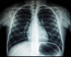 chest-x-ray-29