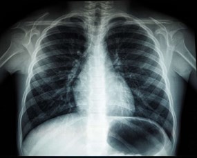chest-x-ray-29