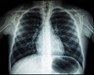 chest-x-ray-29